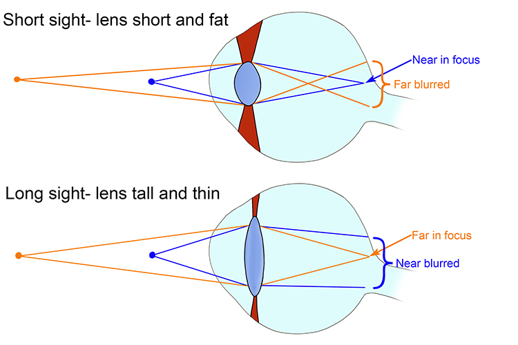 When the lens is shaped for short sighting the long distances will seem blurred because the image on the retina is bigger also the lens can only be shaped for longer or shorter and not both